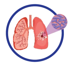tuberculosis